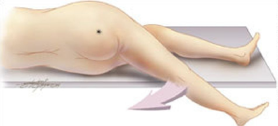 Sinal do Psoas. Fonte: https://cbcsp.org.br/wp-content/uploads/2016/aulas/ApendiciteAguda.pdf