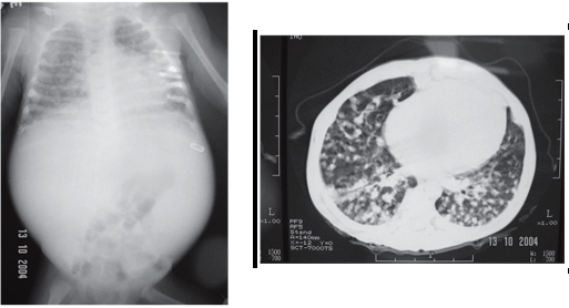 Raio-X e tomografia computadorizada evidenciando padrão-miliar. Fonte: https://www.scielo.br/j/bjid/a/3Q8KjsvfhNgfsC44WWMVc8J/?lang=en#
