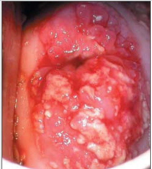 Imagem de colposcopia de neoplasia invasiva de colo de útero. Fonte: https://screening.iarc.fr/colpochap.php?lang=4&chap=8.php