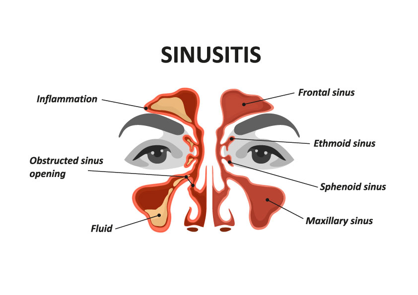 Anatomia dos seios paranasais e os principais sinais de inflamação. Foto: Reprodução/ShutterStock