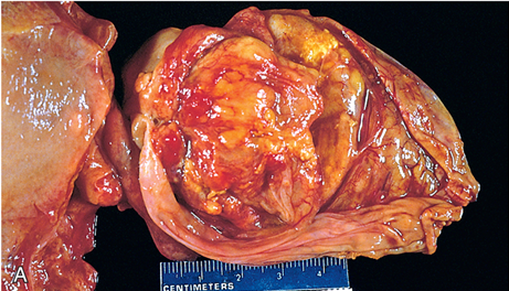 Observe essa vesícula biliar aberta, que contém um grande tumor exofítico, preenchendo quase todo o lúmen. Fonte: Bases Patológicas das Doenças, 2021