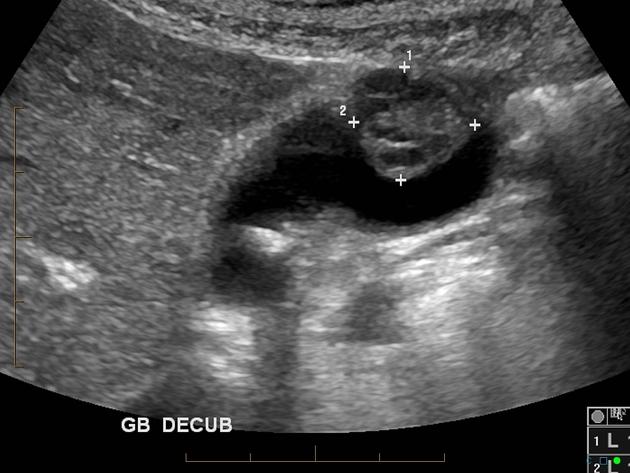 USG mostrando massa polipóide de 2cm no lúmen, com vascularização e cálculos. Fonte: Radiopaedia