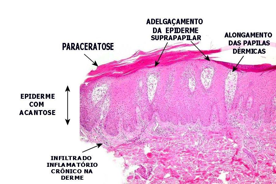Aspecto da psoríase no âmbito histológico. Fonte: Anatpat (https://anatpat.unicamp.br/lampele1.html)