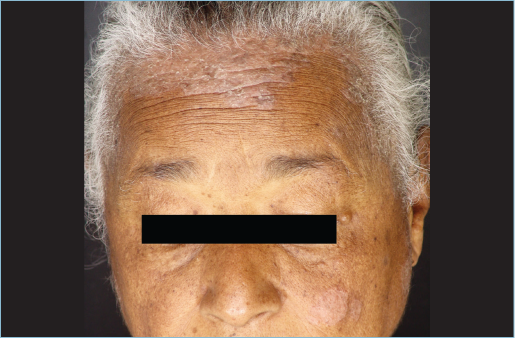 Psoríase crônica em placas acometendo o couro cabelo. Fonte: Fonte: Manual de Dermatologia, 2019