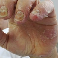 Unha de paciente com psoríase. Fonte: Sociedade Brasileira de Dermatologia