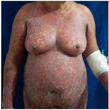 Psoríase eritrodérmica. Perceba que grande parte da superfície corpórea foi acometida. Fonte: Revista Médica de Minas Gerais http://www.rmmg.org/artigo/detalhes/2261
