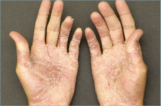 Lesões de psoríase palmar. Fonte: Fonte: Manual de Dermatologia, 2019
