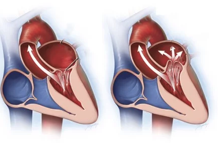 Observe, nessa ilustração o refluxo sanguíneo do ventrículo esquerdo para os átrios durante a sístole. Fonte: Brazilian Journal of Cardiovascular Surgery Blog