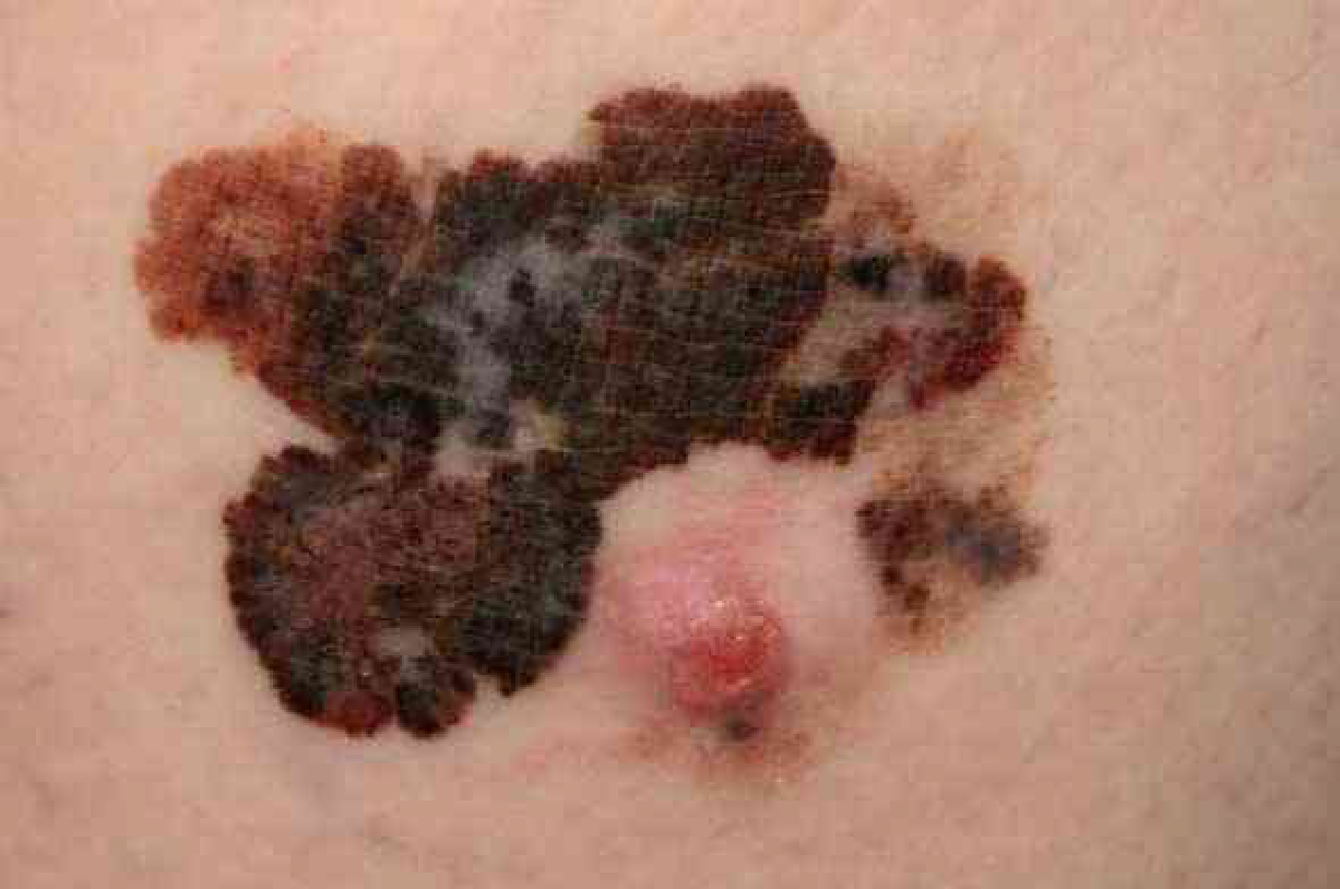 Melanoma extensivo-superficial. Fonte: Dermatologia Bolognia