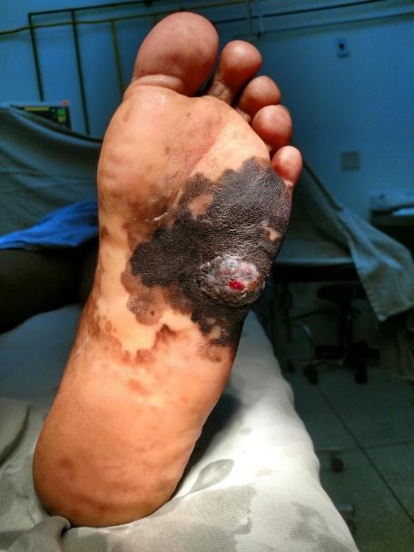 Melanoma Acral. Fonte: Atlas Cirúrgico