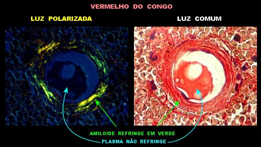 Biópsia para diagnóstico dos distúrbios de enovelamento de proteínas amilóides. Fonte: Anatpat (https://anatpat.unicamp.br/nptangioamiloide2b.html)