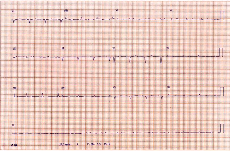 Eletrocardiograma de paciente com AL. Observe a baixa voltagem. Fonte: Cardiopapers (https://cardiopapers.com.br/que-exames-complementares-pedir-na-suspeita-de-amiloidose-cardiaca/)