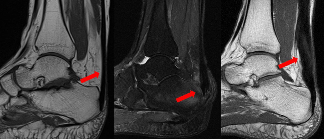 RNM mostrando calcificação do tendão de Aquiles. Fonte: Dr. Rodrigo Macedo https://drrodrigomacedo.com.br/2022/04/16/tendinites-do-tendao-de-aquiles/