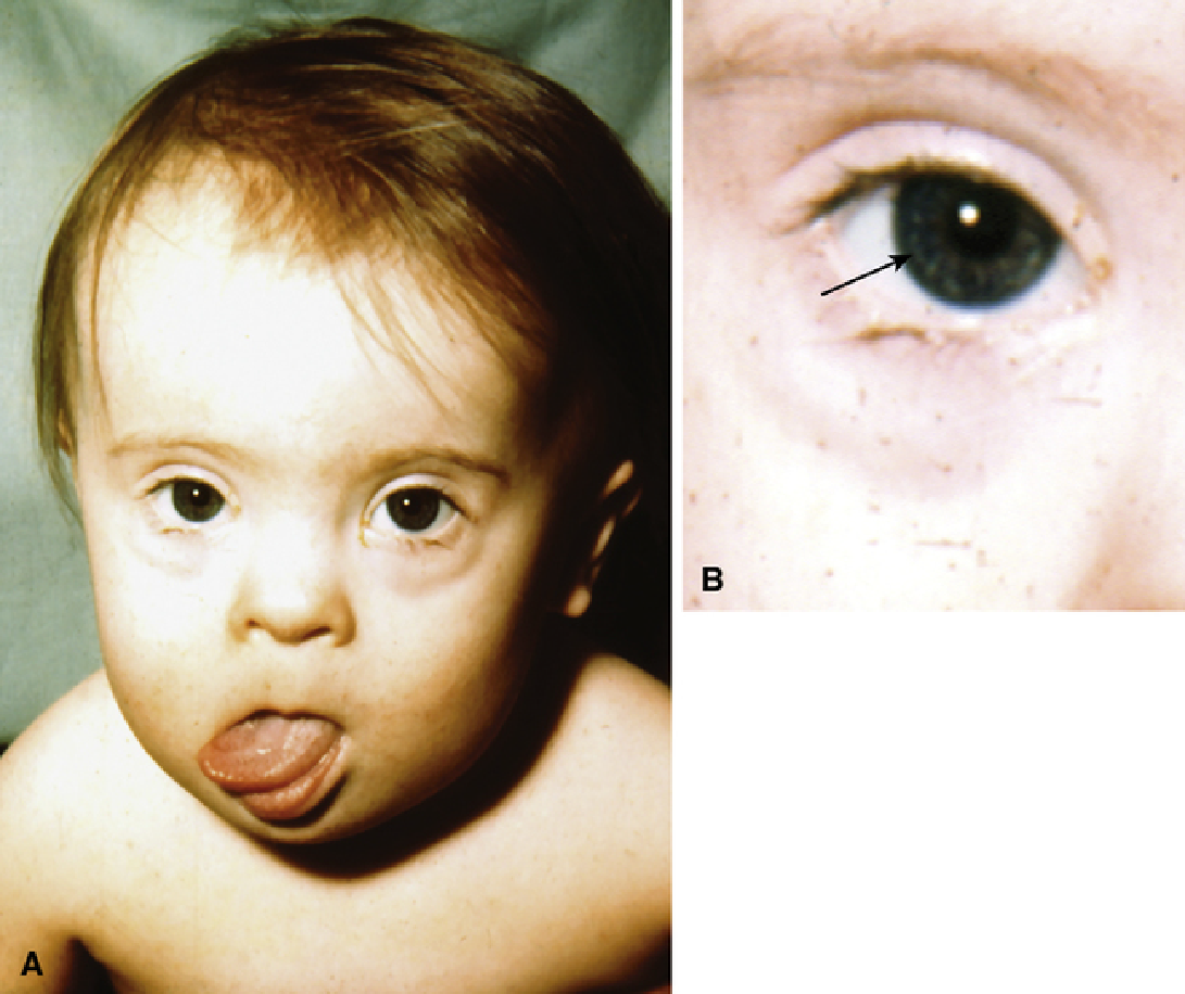 Fenótipo da síndrome de Down. A. A ponte nasal é plana; as orelhas apresentam baixa implantação e têm um aspecto dobrado típico; os olhos apresentam pregas epicânticas típicas e fissuras palpebrais com inclinação ascendente; a boca é aberta, mostrando língua saliente. B. Manchas de Brushfield em volta da margem da íris (seta). Fonte: Thompson & Thompson Genética Humana