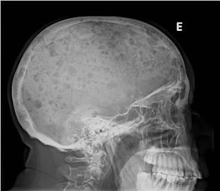 Crânio com lesão em “sal e pimenta” ou “queijo suíço”. Este tipo de lesão não ocorre apenas no crânio. Fonte: Blog dicas radiologia