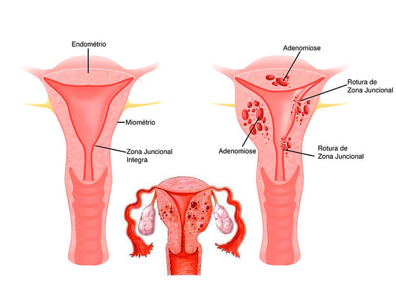 Útero normal e útero com adenomiose. Fonte: Endomulher