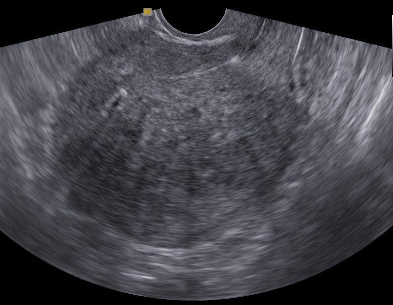 USG sugestiva de adenomiose. Fonte: Dr. Fernando Guastella https://fernandoguastella.com.br/o-que-e-adenomiose-diagnostico-e-tratamentos/