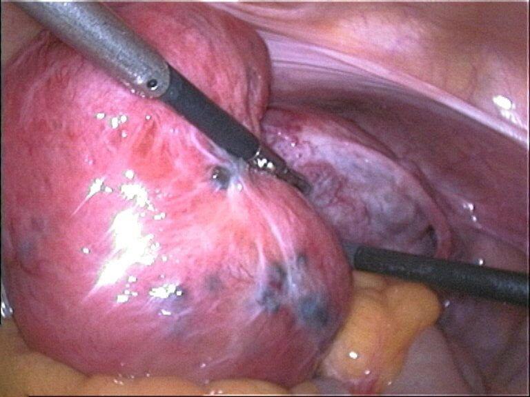 Laparoscopia, demonstrando um útero aumentado e amolecido, achado comum na adenomiose, associado a focos de endometriose em sua superfície. Fonte: Dr. Fernando Guastellahttps://fernandoguastella.com.br/endometriose-na-bexiga/