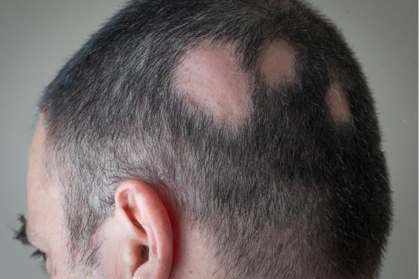 A alopecia areata provoca a perda de cabelo em placas ovais ou circulares . Fonte: Pfizer