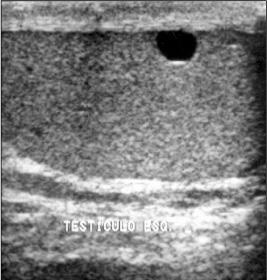Imagem de USG mostrando cisto no terço médio do testículo esquerdo. Fonte: Colégio Brasileiro de Radiologia e Diagnóstico por Imagem