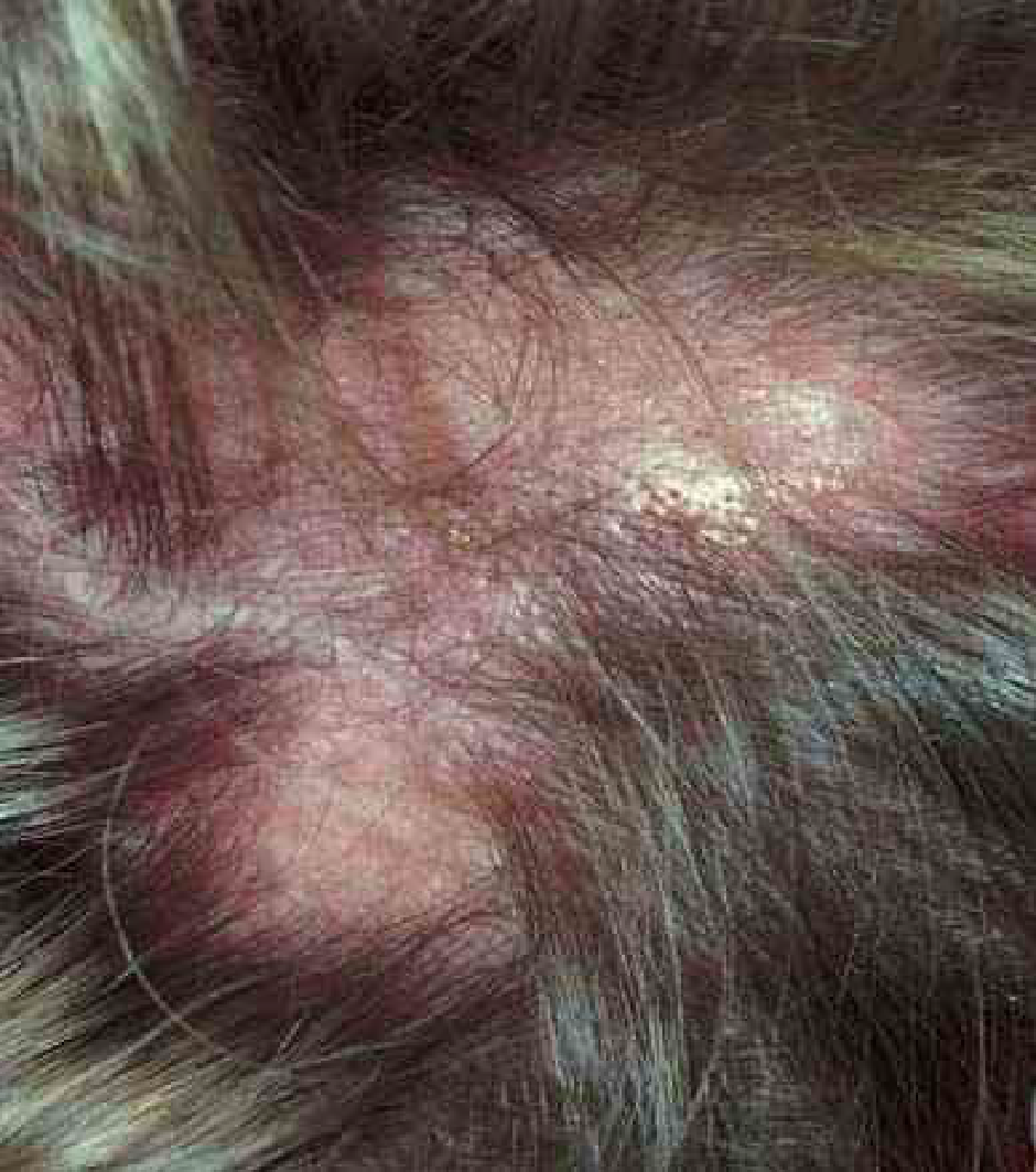 Lesões discoides de lúpus. Fonte: Dermatologia Bolognia, 3ª edição