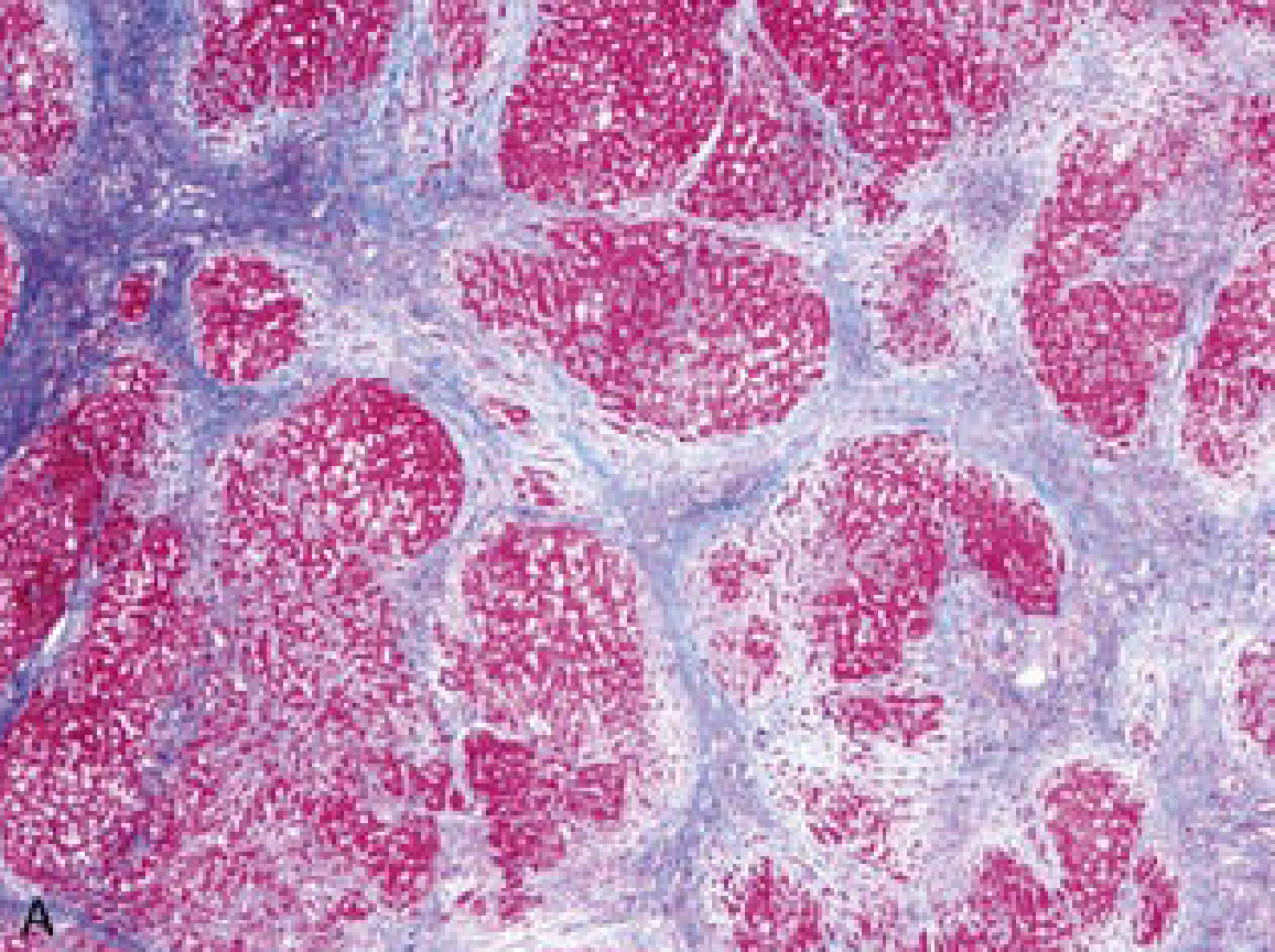 Perda da arquitetura lobular hepática, com fibrose (em azul) e nódulos regenerativos que não se comunicam entre si. Além disso, há diminuição do número total de hepatócitos. Fonte: Robbins patologia 9ª edição.