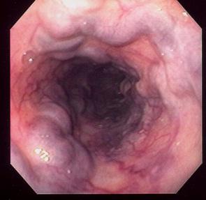 Varizes esofágicas em endoscopia digestiva alta. Fonte: MedicinaNet