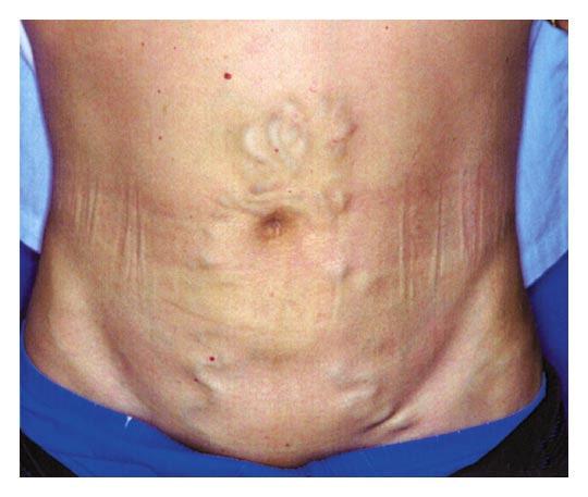 Circulação colateral periumbilical (caput medusae).