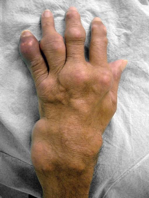 Gota origem, tipos e tratamentos