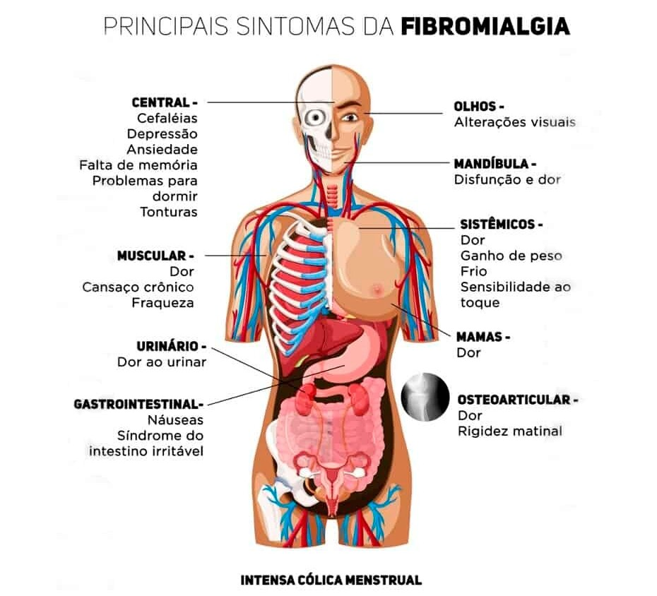 Fibromialgia: Etiologia, Diagnóstico e Tratamento