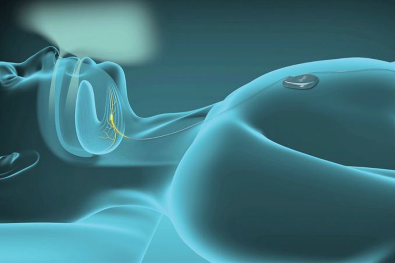 Ditch the Mask! The Newest Treatment for Sleep Apnea