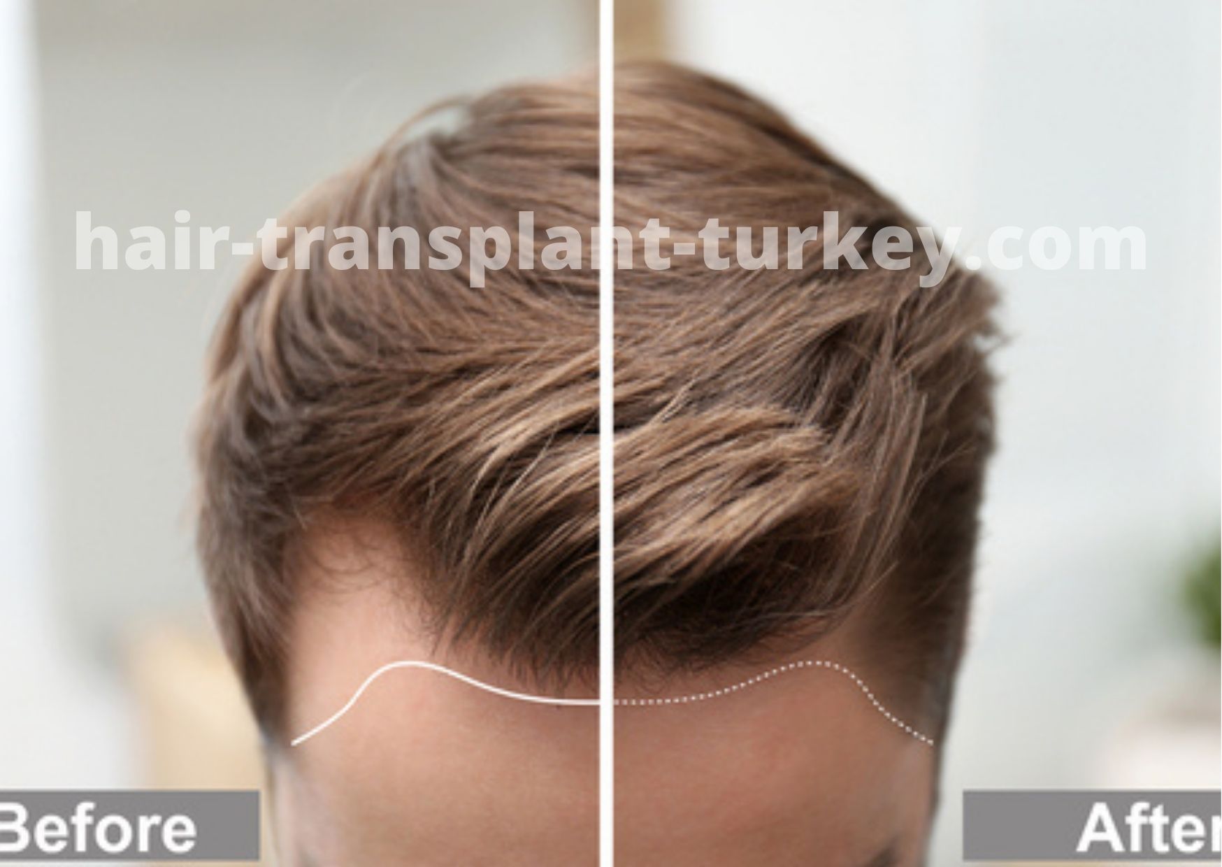 Is hair transplant in Ahmedabad advisable? Or should I go for Mumbai? -  Quora