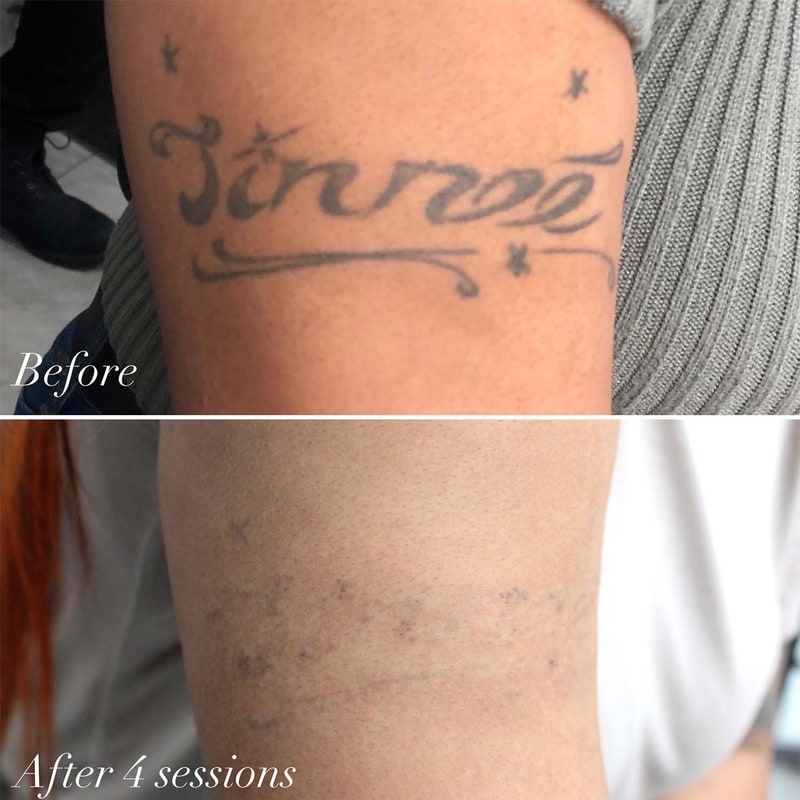 CHNG Laser Tattoo Removal New York City