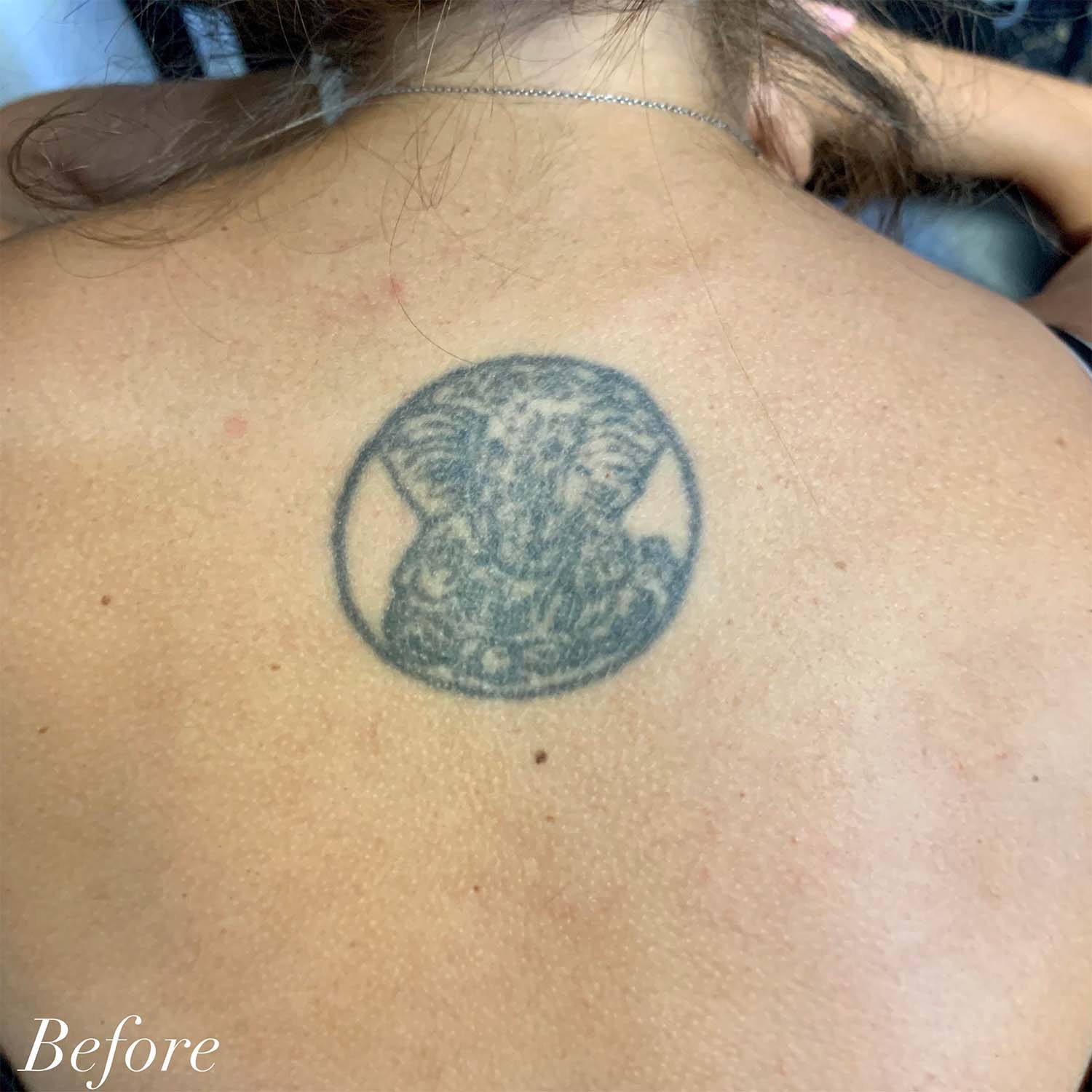 CHNG | Laser Tattoo Removal | New York City