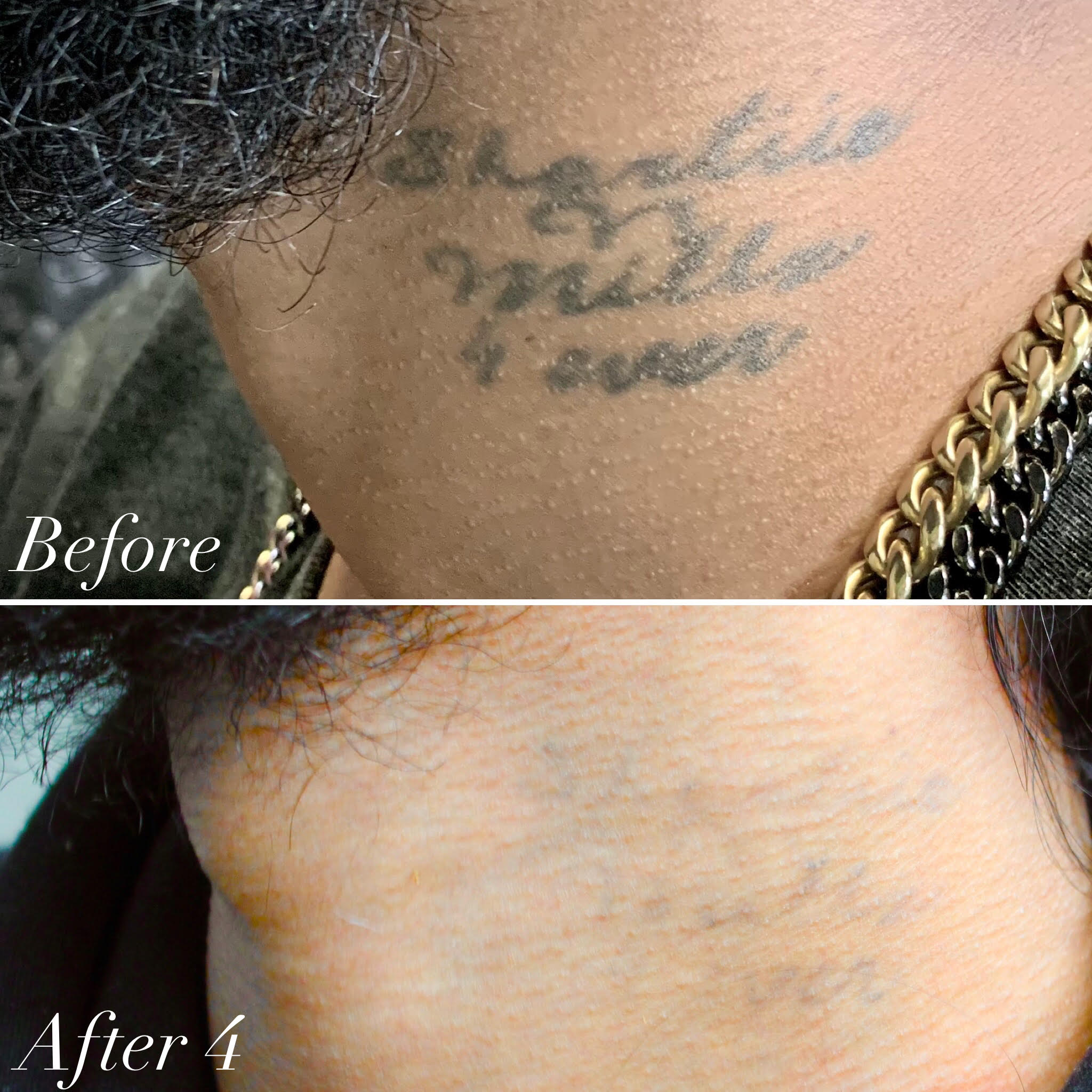 CHNG Laser Tattoo Removal New York City
