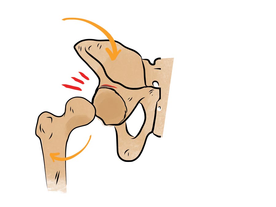 Torn Hip Labrum Symptoms Finding the Cause of your Hip Pain