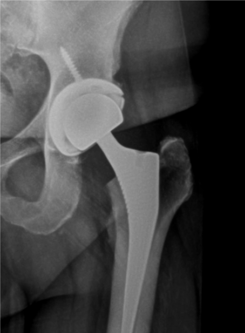 Hip Arthritis And Replacement Orthopedic Centers of Colorado